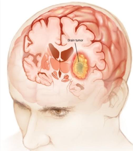 Tumor Segmentaion