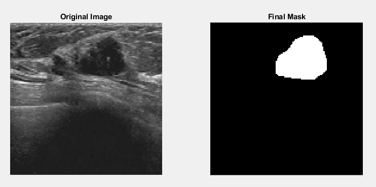 Tumor Detection