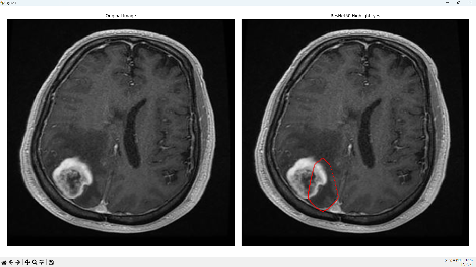 Tumor Detection